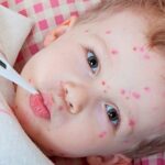 Кір - дуже заразне і серйозне захворювання